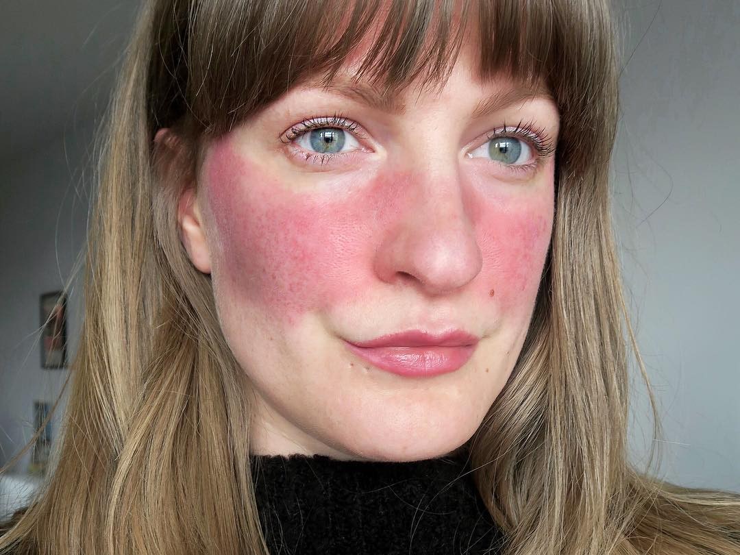 Acne Rosacea Or Couperose Skin Similarites And Differences